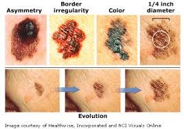 La incidencia del melanoma de piel aumenta en Navarra