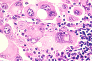 Las células del melanoma. Imagen cortesía del Instituto Nacional del Cáncer.