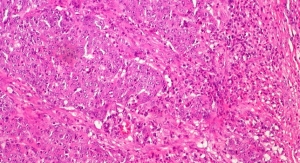 Muestra de un carcinoma medular de colon