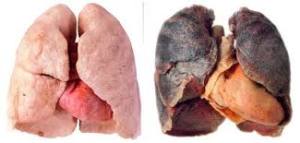 Diferencias entre pulmones con cáncer avanzado y sanos. sipse.com