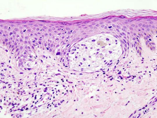 Demuestran que los cannabinoides potencian la muerte celular en melanomas