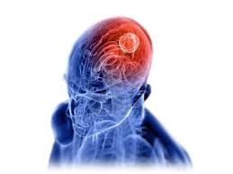 Una punción lumbar permitirá el diagnóstico precoz de tumores cerebrales