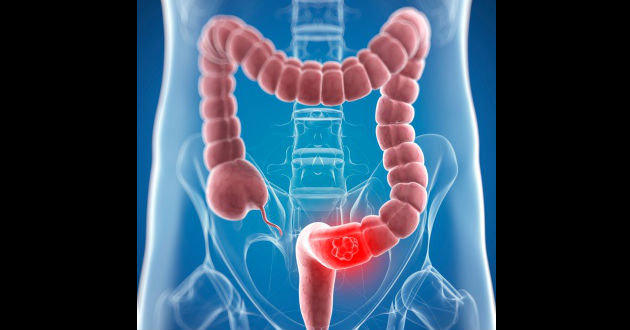 Un gen puede convertir células de cáncer colorrectal de ratones en tejido sano de nuevo