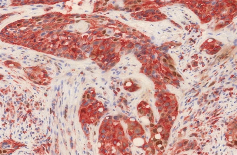 Día del cáncer: Nuevos marcadores tumorales para el pronóstico del cáncer de cabeza y cuello