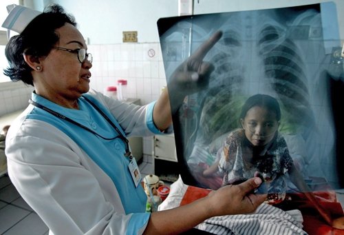 Tuberculosis, avances y retos