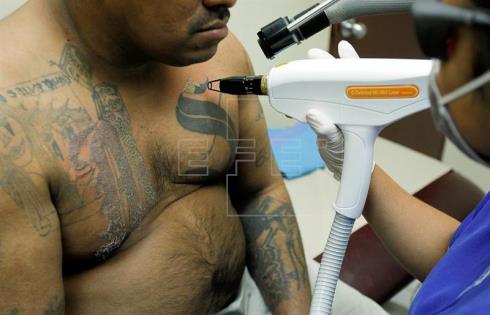 Borrar tatuajes, una cura a las heridas de marginación de los salvadoreños