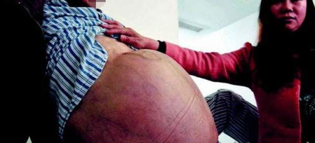 Médicos chinos extirpan un tumor de 31 kilos, uno de los mayores del mundo