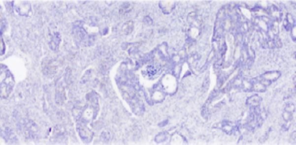 Prueban que hay distintos tipos de células dentro de un tumor
