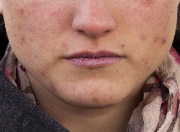 Falsos mitos del acné que hay que desmontar