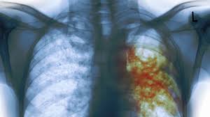 La clave del éxito de la expansión de la tuberculosis