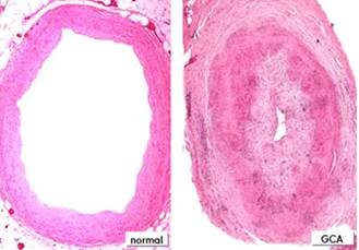 La genética abre la puerta a nuevos fármacos contra una patología vascular