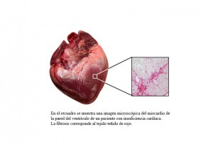 CIMA y Clínica Universidad de Navarra identifican molécula clave en insuficiencia cardiaca