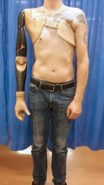 Desarrollan un brazo protésico que detecta señales de la médula espinal