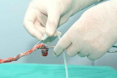La sangre del cordón umbilical podría usarse para tratar la diabetes y la esclerosis múltiple