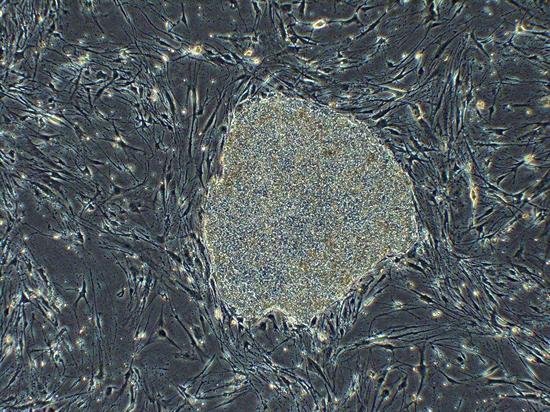Primer trasplante en humanos con células iPS de donante