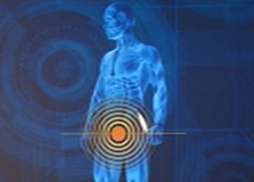 Ciclos ondas choque y embolización endovascular, terapias disfunción eréctil