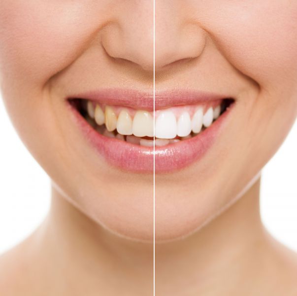10 mitos y verdades sobre el blanqueamiento dental