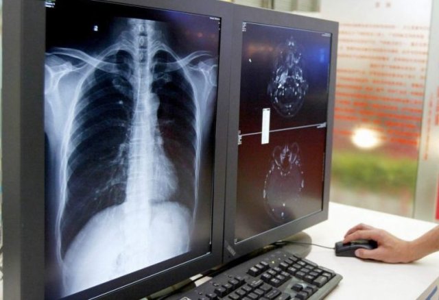 Osteoporosis: Hallan mutación en los fármacos que debilita los huesos