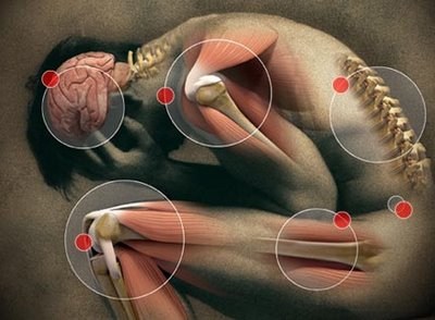 Día Mundial del Dolor: El dolor neuropático, uno de los más complejos