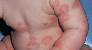La sequedad ambiental agrava los casos de dermatitis atópica