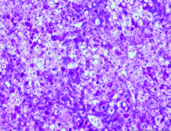 Creado por primera vez un modelo de tumor de hígado humano