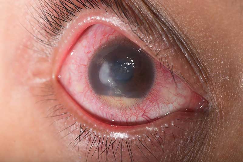 Unas 300 personas diagnosticadas de Glaucoma podrían sufrir ceguera total en Navarra