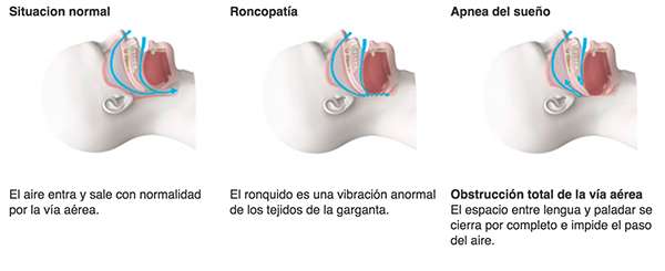 La cirugía ortognática, capaz de curar el 95% de los casos de apnea obstructiva del sueño