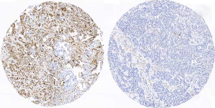 Investigadores españoles hallan los primeros indicadores para pronosticar el cáncer de mama triple negativo