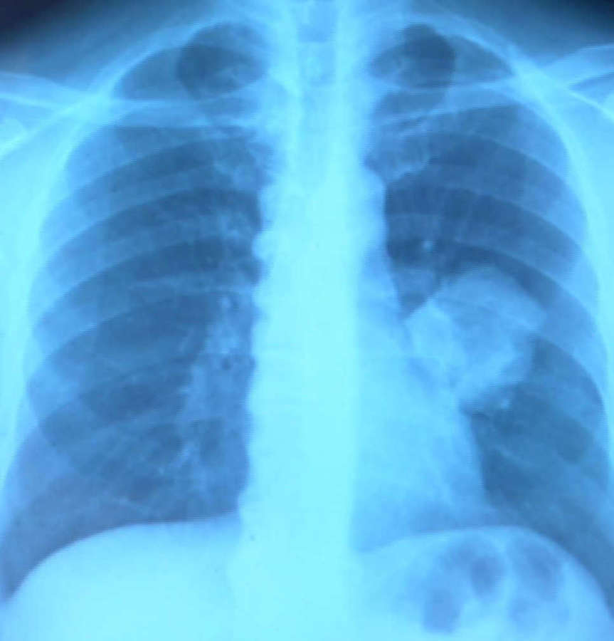 La Clínica UN incorpora cirugía robótica para tratar el cáncer de pulmón