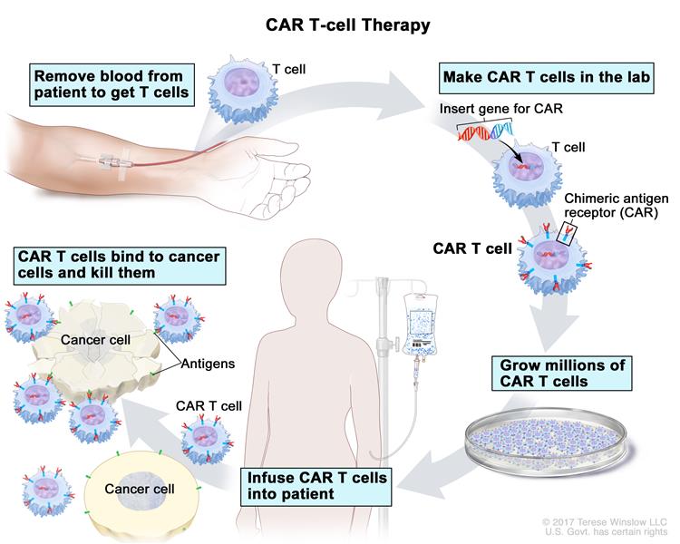 CAR T contra el cáncer hematológico: esperanza para algunos casos irreversibles