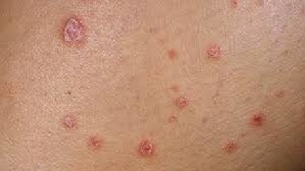 Los pacientes con psoriasis y artritis psoriásica muestran su experiencia en el Buen Camino
