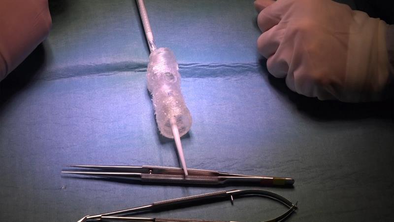 El Marañón salva a un paciente con la aorta rota gracias a la impresión 3D