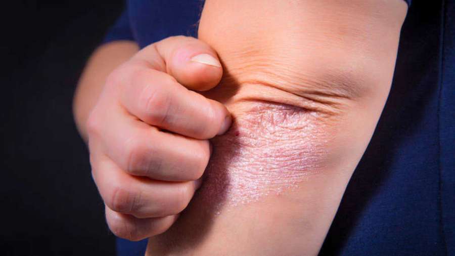 La psoriasis afronta el reto de mejorar la relación médico-paciente y la medición del resultado