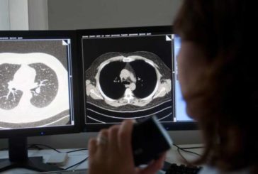 CUN: En marcha la terapia dirigida como tratamiento permanente en cáncer de pulmón